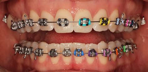 dental orthodontic metal brackets|stainless steel orthodontic braces.